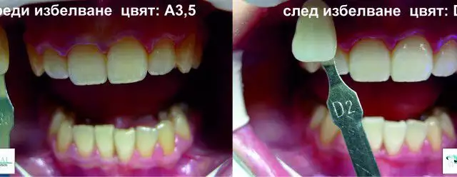 3. Снимка на Избелване на зъби - Doctor Dent София