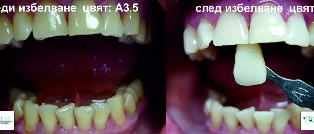 4. Снимка на Кабинетна система за избелване на зъби BMS White - Italy