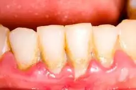 4. Снимка на Почистване на Зъбен Камък и Полиране на Зъбите