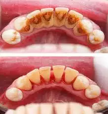 7. Снимка на Почистване на Зъбен Камък и Полиране на Зъбите
