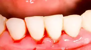 5. Снимка на Почистване на Зъбен Камък и Полиране на Зъбите