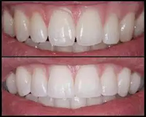 6. Снимка на Почистване на Зъбен Камък и Полиране на Зъбите