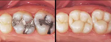8. Снимка на Почистване на Зъбен Камък и Полиране на Зъбите