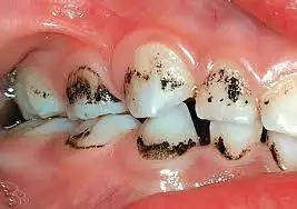 2. Снимка на Почистване на Зъбен Камък и Полиране на Зъбите