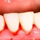 . Снимка на Почистване на Зъбен Камък и Полиране на Зъбите