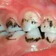 . Снимка на Почистване на Зъбен Камък и Полиране на Зъбите
